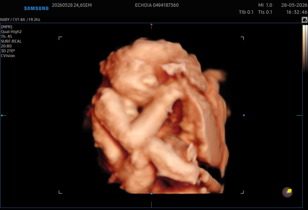 Echographie affective en 5D réalisée à 25 semaines 