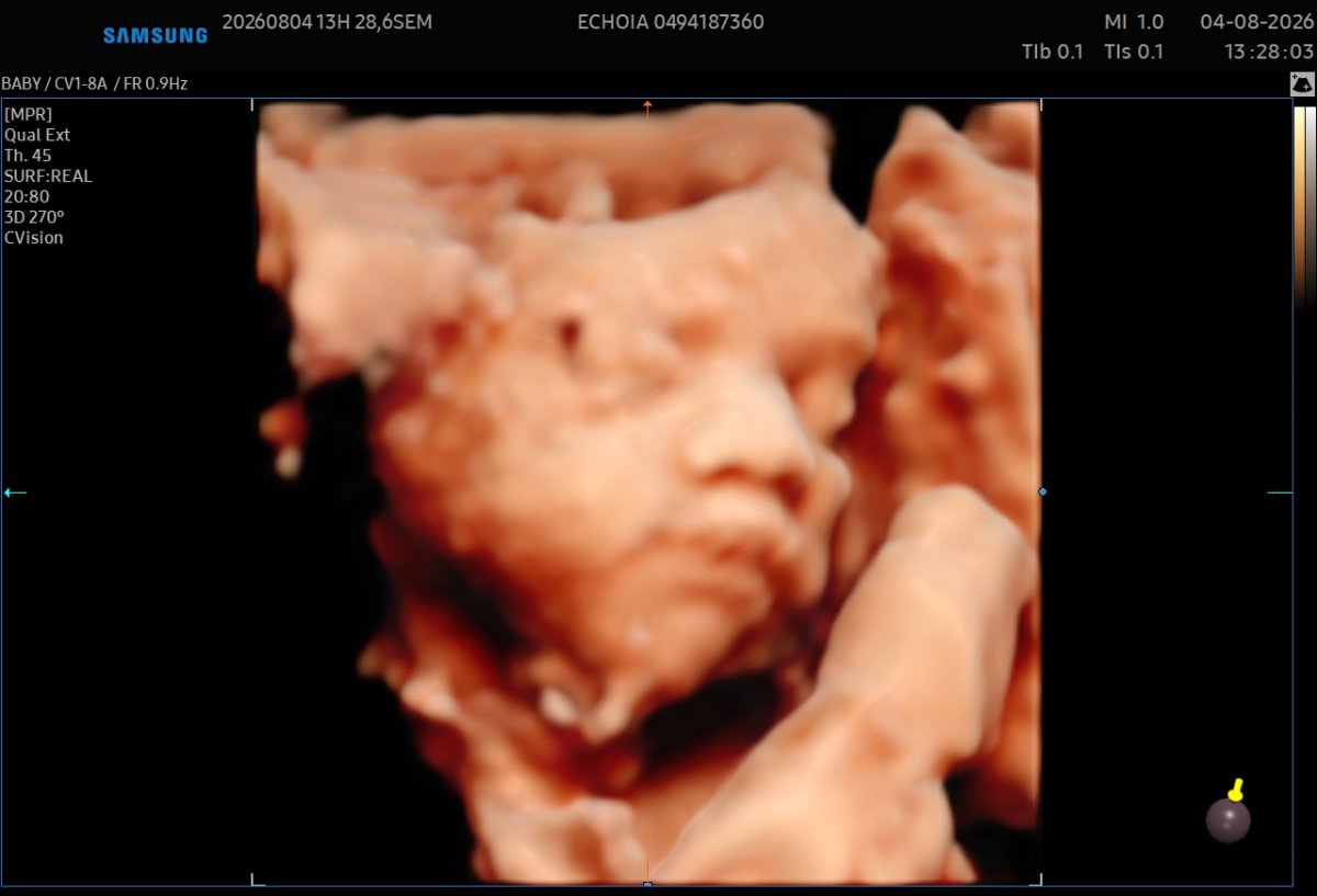 Echographie affective en 5D réalisée à 29 semaines 
