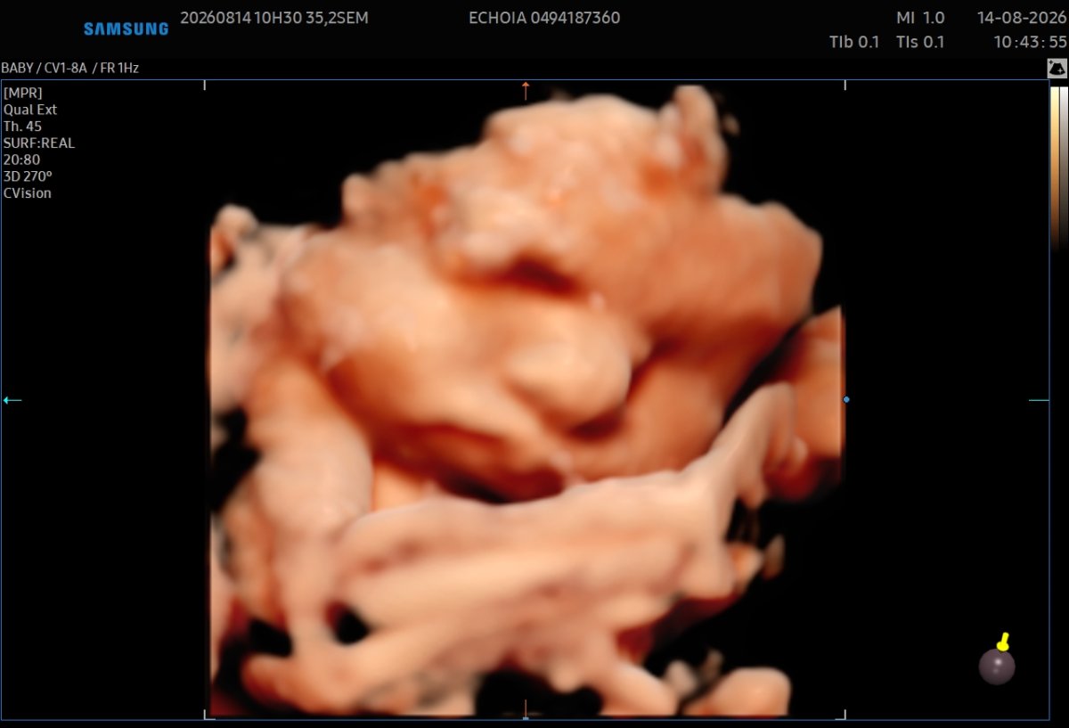 Echographie affective en 5D réalisée à 35 semaines 
