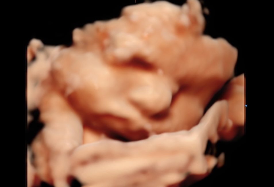 À partir de quand peut-on faire une échographie 3D pendant la grossesse ? 